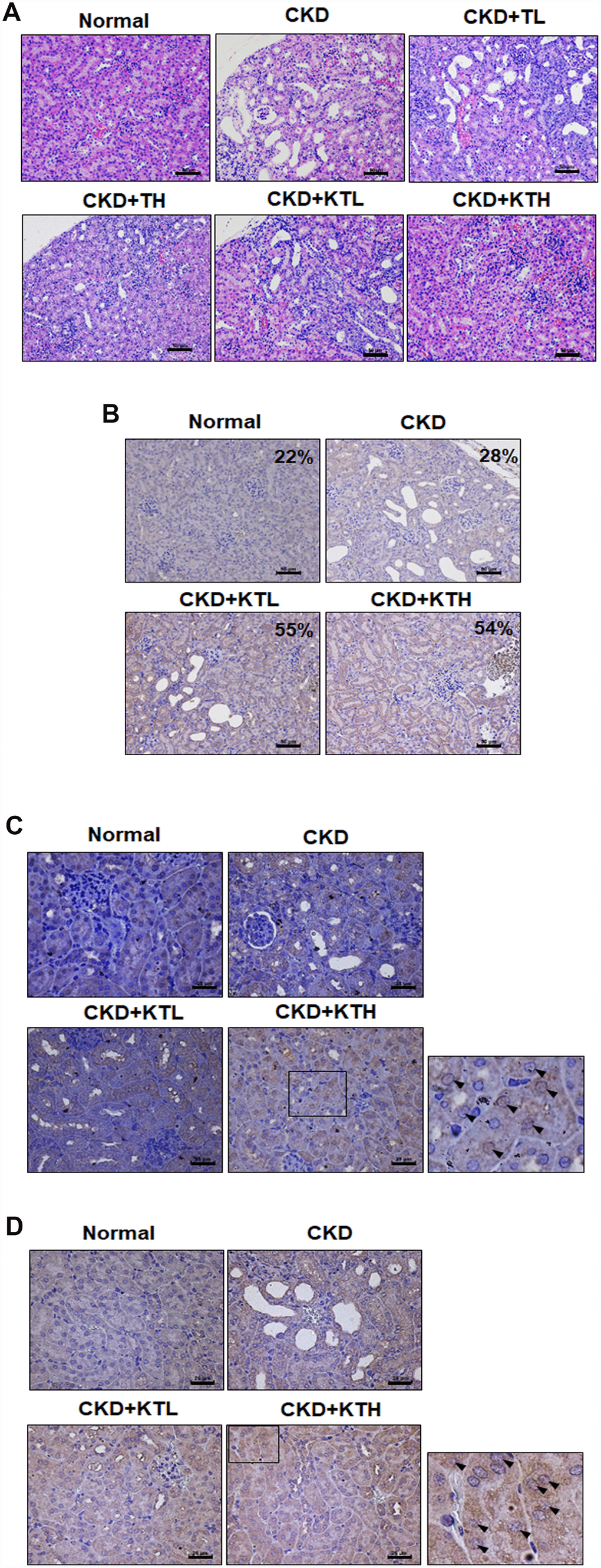 TG NPs and KIM-1-TG NPs protect against tubulointerstitial injury in mice with CKD induced by adenine. (A) Representative photographs of histological changes showing sections of renal tissue from mice after H&E staining. Immunohistochemical analysis of the protein expression of LC3 (B), FoxO1 (C) and Nrf2 (D) in the sections of renal tissue. The percentage of LC3-positive cells was determined using HistoQuest software (TissueGnostics). (A, B) Scale bar = 50 μm. (C, D) Scale bar = 25 μm.