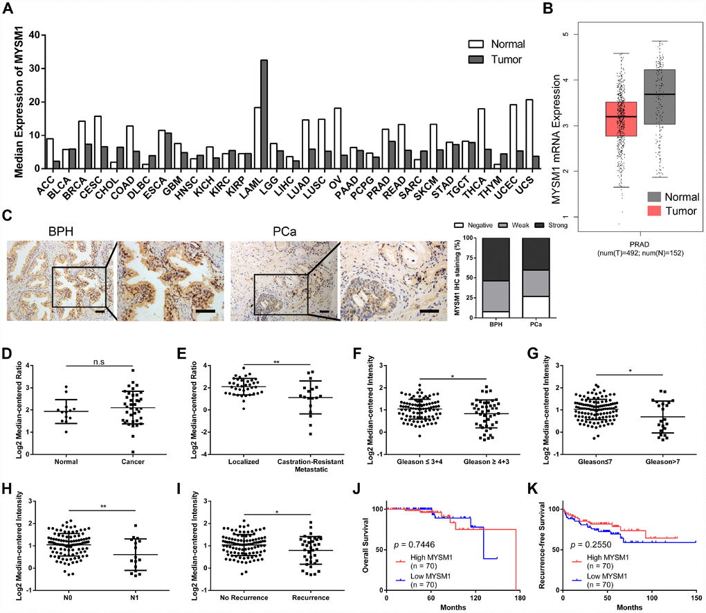 MYSM1 is downregulated in castration-resistant prostate cancer and inversely correlated with progression of prostate cancer. (A) Pan-cancer analyses for mean expression levels of MYSM1 in different types of cancers. (B) MYSM1 mRNA levels in prostate cancers (T = tumor, N = normal, PRAD = prostate adenocarcinoma). Data (A–B) were acquired from TCGA database and analyzed via GEPIA bioinformatics. (C) Representative IHC staining images of MYSM1 in benign prostatic hyperplasia (BPH) and prostate cancer (PCa) tissues. Scale bars are 20 μm. (D–E) MYSM1 expression levels based on Grasso Prostate dataset from Oncomine database. (F–I) MYSM1 is differentially expressed in prostate cancer patients and data acquired from Taylor Prostate 3 cohort are analyzed based on Gleason grade (F), Gleason score (G), N stage (H) and recurrence status (I) via Oncomine database. Data are shown as mean ± SD. n.s = no significance, * P J–K) Correlation of MYSM1 with overall survival (J) and recurrence-free survival (K) in prostate cancer patients (n = 140). Data were acquired from Taylor Prostate 3 cohort via Oncomine database. Log-rank test was applied to determine the significance levels.