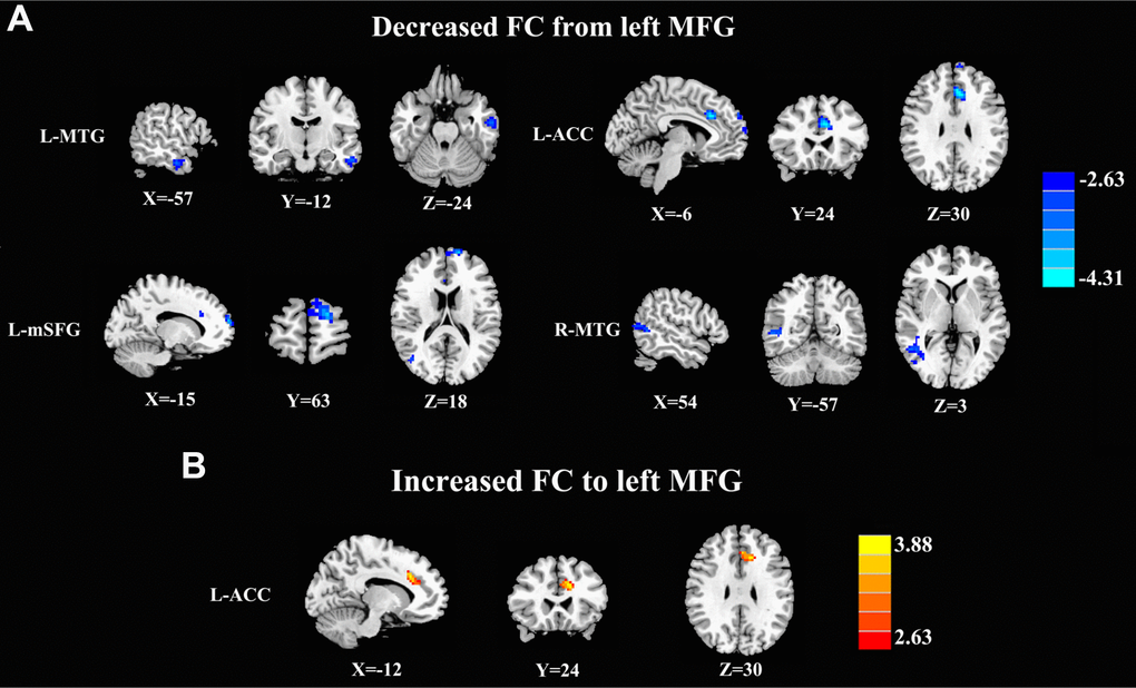 Aberrant causal connectivity from the bilateral SFG in mTBI patients at the acute stage. (A) Decreased causal connectivity from the left MFG to the L-MTG, R-MTG, L-ACC, and L-mSFG. (B) Increased causal connectivity from the left MFG to the left ACC. L, left; R, right; MFG, middle frontal gyrus; MTG, middle temporal gyrus; ACC, anterior cingulate cortex; mSFG, medial superior frontal gyrus.
