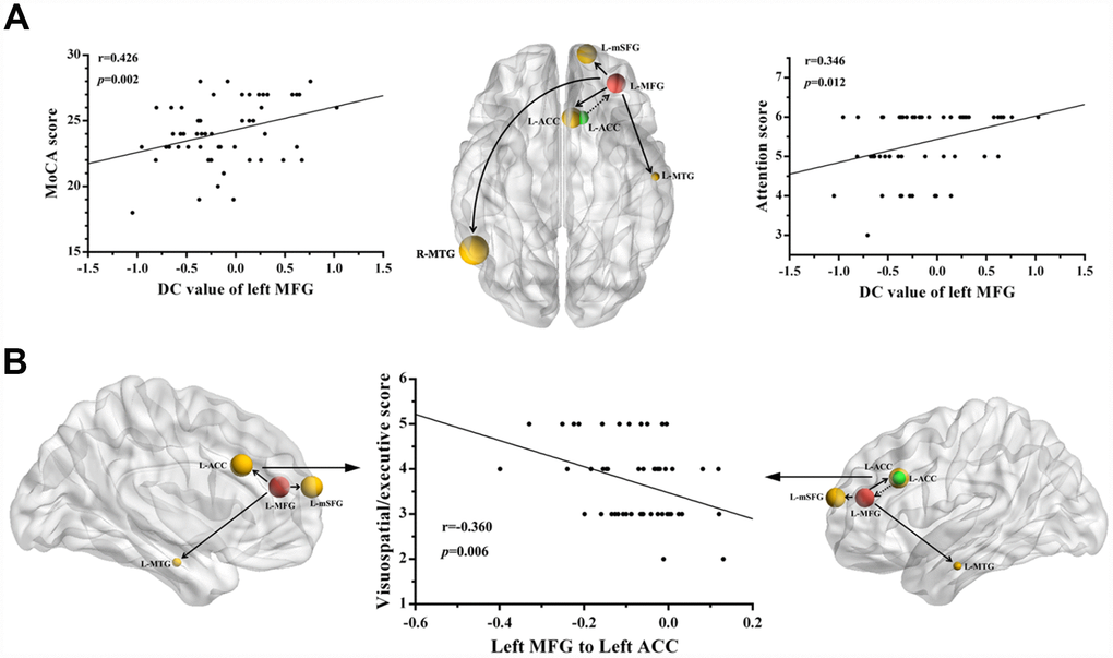 Correlations between the changes in degree centrality (DC) and causal connectivity and deficits in cognitive performance in mTBI patients at the acute stage. (A) The decreased DC in left MFG was positively correlated with the total MoCA scores (r = 0.426, p = 0.002) and the attention scores (r = 0.346, p = 0.012). (B) The visuospatial/executive score was negatively correlated with the decreased causal connectivity from the left MFG to left ACC (r = 0.360, p = 0.006). The full line represents the decreased causal connectivity and the dotted line represents the increased causal connectivity. L, left; R, right; MFG, middle frontal gyrus; MTG, middle temporal gyrus; ACC, anterior cingulate cortex; mSFG, medial superior frontal gyrus; MoCA, Montreal Cognitive Assessment.