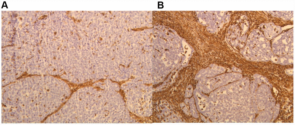 IHC staining of alpha- SMA in the tumor stroma before (A) and after (B) p62 DNA treatment. (20 ×).