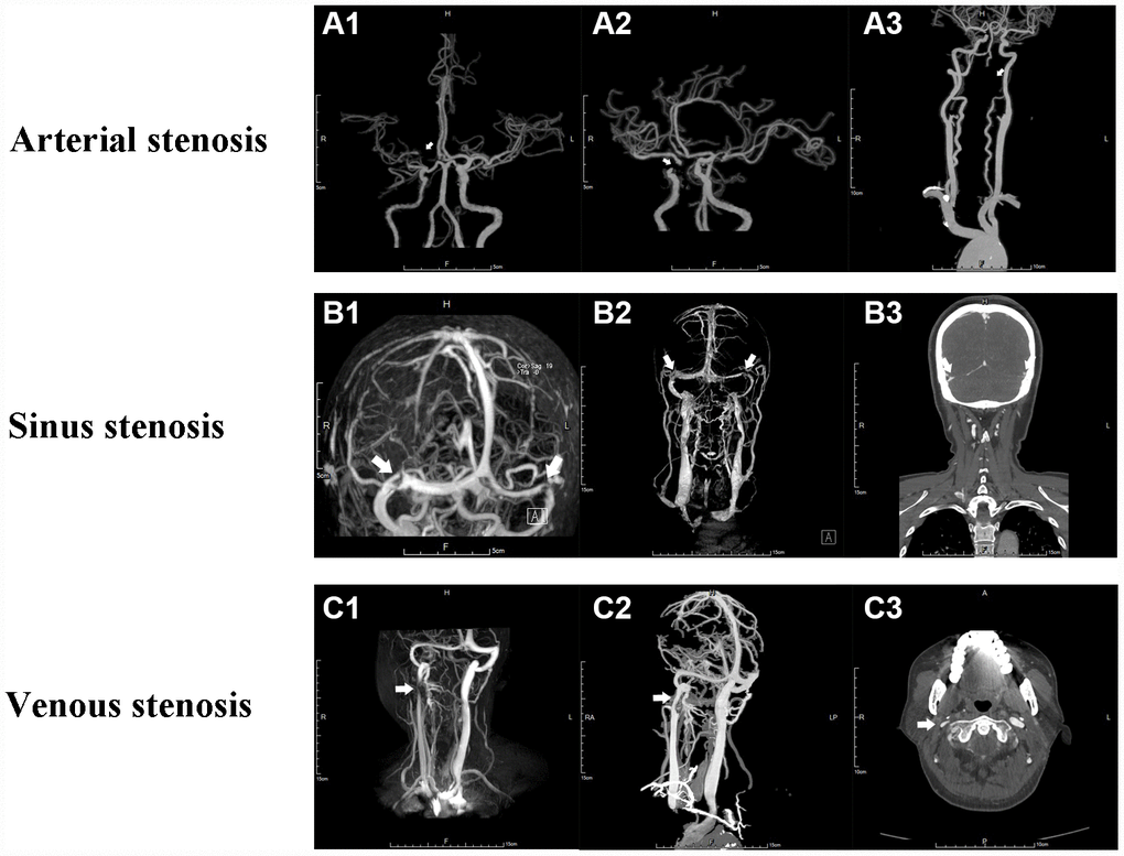 Angiography of cerebral arterial and venous stenosis. (A1–A3) Typical CAS represented by right MCA stenosis, right ICA stenosis and left VA stenosis on CTA respectively. (B1–B3) Bilateral cerebral transverse sinus stenosis presented on MRV and CTV. (C1-C3) Right IJVS J3 segment stenosis presented on MRV and CTV. The stenoses are indicated by arrows.