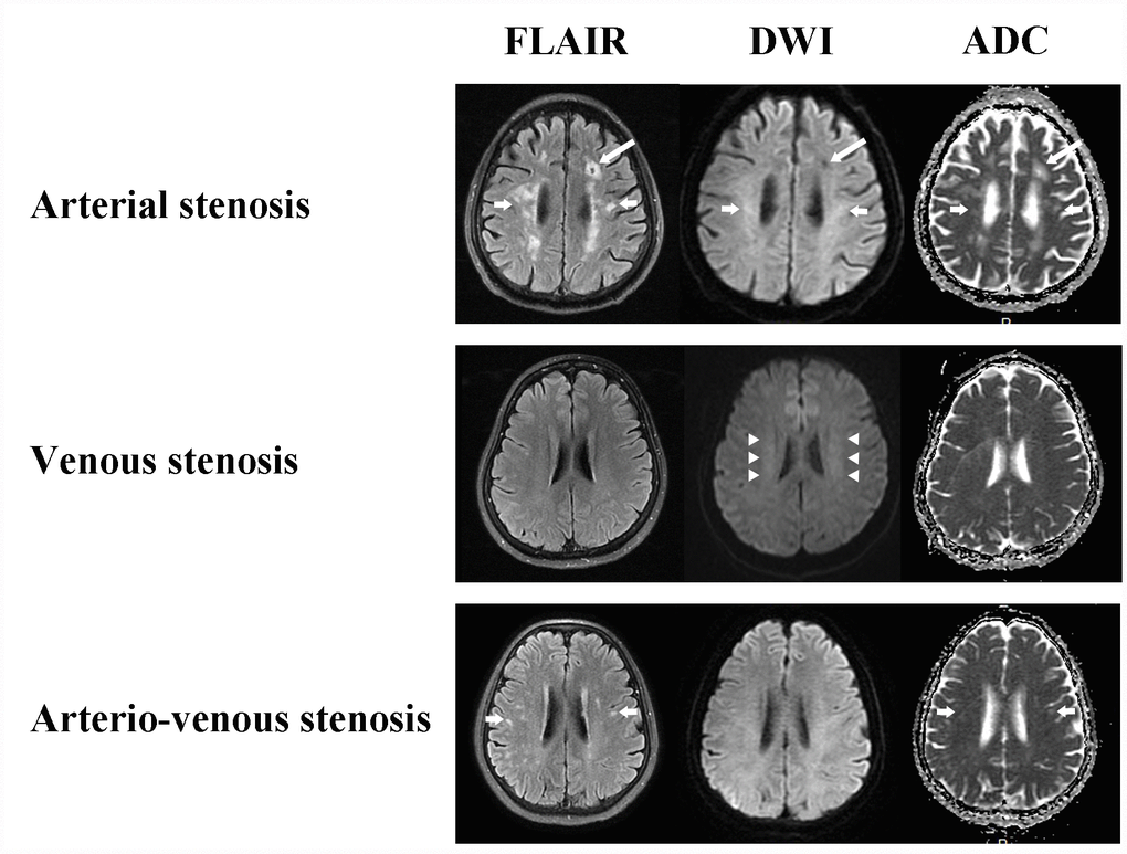 White matter changes of CAS, CVS and CAVS on MRI maps. Arterial stenosis always causes cavity (long arrows) and non-symmetrical multiple round, ovoid, patch and fused hyperintensity lesions with clear boundaries (short arrows). Venous stenosis conduces bilateral and symmetrical cloudy-like white matter hyperintensity surrounding ventricles and centrum semiovale (arrow heads). Arterio-venous stenosis also has non-symmetrical focal white matter lesions (short arrows).