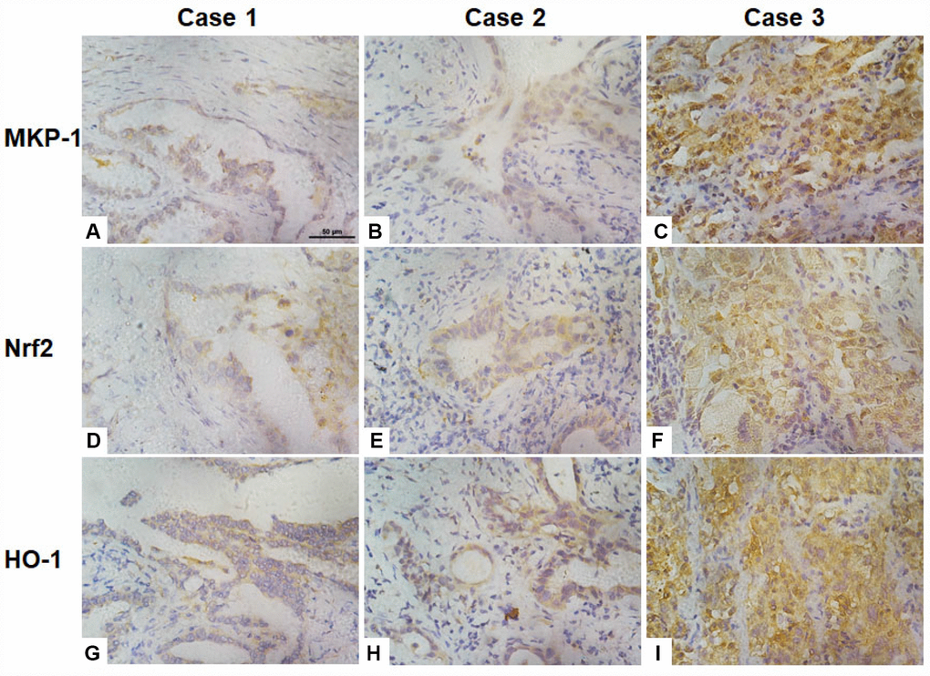 Association of the expression of Nrf2, MKP-1, and HO-1 in human lung adenoma tissues. Images of immunochemical staining for MKP-1 (A–C), Nrf2 (D–F), and HO-1 (G–I) from three representative lung adenoma tissues. Case 1, well-differentiated adenoma with weak positive staining for MKP-1 (A), Nrf2 (D), and HO-1 (G). Case 2, moderately-differentiated adenoma with moderate positive staining for MKP-1 (B), Nrf2 (E), and HO-1 (H). Case 3, poorly-differentiated adenoma with strong positive staining for MKP-1 (C), Nrf2 (F), and HO-1 (I). Original magnification ×400; scale bar, 50 μm.