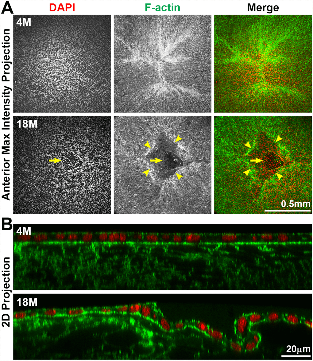 Whole lens staining for F-actin (phalloidin, green) and nuclei (DAPI, red) in 4-month-old and 18-month-old lenses. (A) The maximum intensity projection of the anterior lens epithelium and underlying fibers in the 4-month-old lens shows evenly distributed epithelial cell nuclei (DAPI) with a normal branched Y-suture (F-actin) under the epithelial cells. In contrast, there is an obvious defect at the apex of the 18-month-old lens with abnormal distribution of epithelial cell nuclei (DAPI, arrows) and a gap in the anterior suture (F-actin, arrowheads). (B) A 2D YZ projection of the 3D reconstruction of a Z-stack through the anterior epithelium and underlying fiber cells in the 4-month-old lens reveals tight adhesion of the anterior epithelial and fibers. In the 18-month-old lens near the fiber cell defect, the anterior epithelial cell layer is wrinkled and is depressed into the gap of the Y-suture. Although there was a defect in the epithelial cell sheet organization, there was no evidence of multilayered epithelial cells or abnormal epithelial cell proliferation in the 18-month-old lens. These results reveal that anterior cataracts in 18-month-old lenses are correlated with detachment and wrinkling of the anterior epithelial cells from the underlying Y-suture formed by fiber cells. Scale bars, 0.5mm in A and 20μm in B.