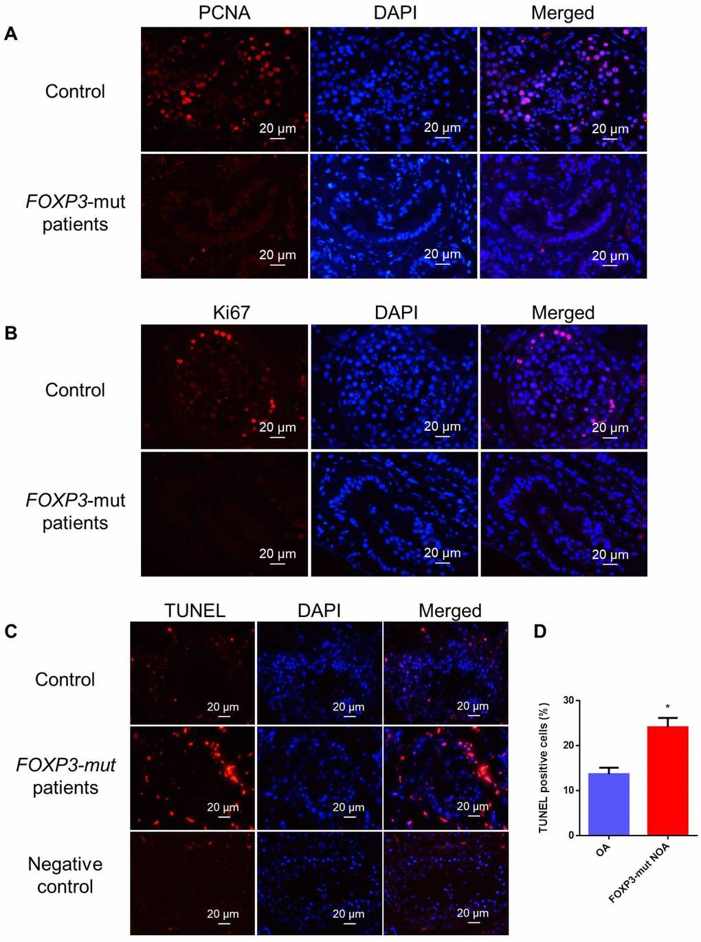 Cell proliferation and apoptosis in the testis of FOXP3-mut NOA patients and OA controls. (A, B) Immunohistochemical staining showed the levels of PCNA (A) and Ki67 (B), the hallmarks for cell proliferation, were decreased in FOXP3-mut NOA patients (lower panels) compared to the OA controls (upper panels). (C) TUNEL assay demonstrated the TUNEL-positive cells (red fluorescence) in FOXP3-mut NOA patients and OA controls. DAPI (blue fluorescence) was used to label cellular nuclei. Replacing the TdT enzyme with PBS was used as the negative control. Scale bars in A-C= 20 μm. (D) The percentages of apoptosis in male germ cells of FOXP3-mut NOA patients and OA controls were calculated using Student’s t-test. All values are means ± SD from three independent experiments. * indicated statistically significant differences (p