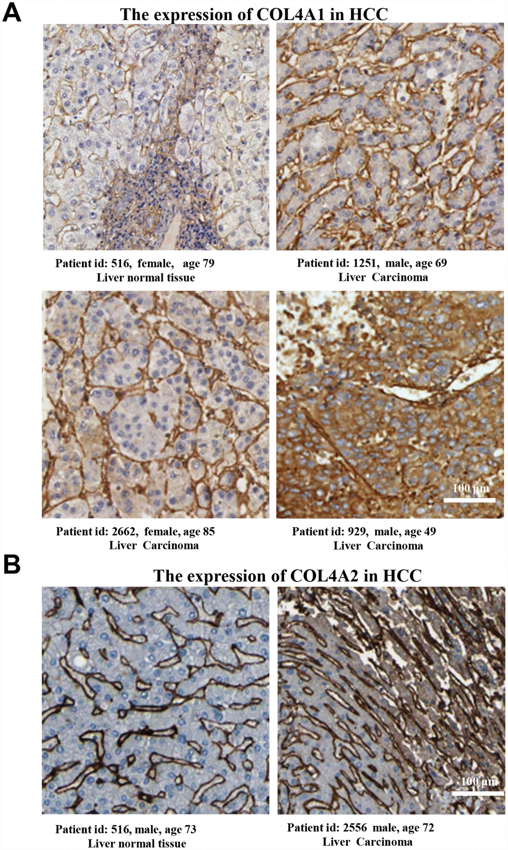 The COL4A1 and COL4A2 proteins were expressed higher in HCC tissues than in the normal liver tissue. (A–B) Immunohistochemistry staining showing the protein expression of COL4A1 (A) and COL4A2 (B) in liver normal tissues and liver carcinoma.