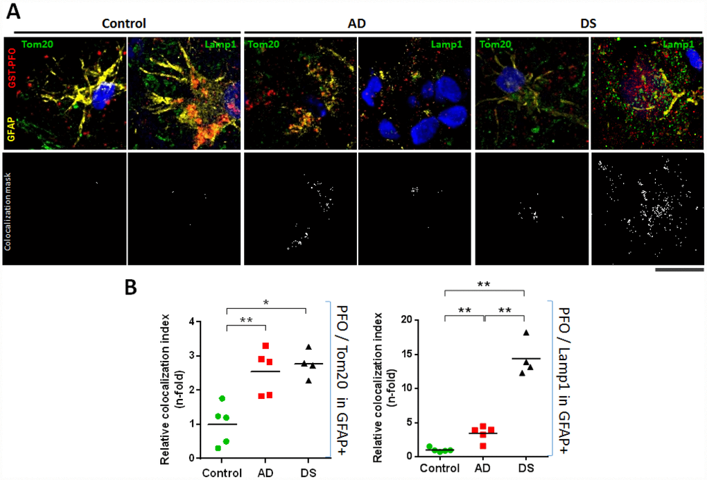 Lysosomal and mitochondrial cholesterol homeostasis in hippocampal astrocytes. (A) Representative confocal representative images of 4 μm thin-stacked cryopreserved hippocampus from AD (n=5), DS (n=4), and control (n=5) subjects immunolabeled with GST-PFO (red), GFAP (yellow), and Tom20 or Lamp1 (both green). Nuclei are stained with Dapi (blue). Lower panels show colocalization mask (white) between GST-PFO and Tom20 or Lamp1, respectively, highlighted in the squared areas. Scale bar: 10 μm. (B) Cholesterol (PFO+) colocalization with mitochondria (Tom20+) or lysosome (Lamp1+) into hippocampal astrocytes (GFAP+) from AD, DS, and control donors. 10 images per sample were analysed with Image J to assess the index of astrocytic cholesterol colocalization with Tom20 or Lamp1. Values are relativized with control to show differences as n-fold. (*) p