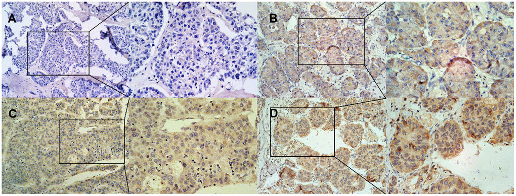 Representative of IHC staining of DNASE1L3 in HCC. (A) negative expression, (B) weakly positive expression, (C) moderately positive expression, (D) strongly positive expression. The left side of the A, B, C, and D pictures is 200X, and the right side is 400X.