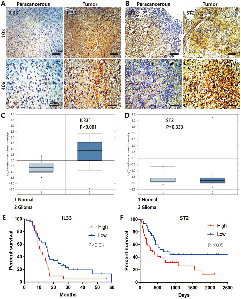 IL-33 and ST2 expression was increased in glioma and correlated with patient prognosis. (A and B) IL-33 and ST2 expression was detected with conventional immunohistochemical staining in clinical glioma samples. The representative images showed IL-33 or ST2 expression was increased in tumor tissues compared with paracancerous tissues. (C and D) The mRNA expression data of glioma compared with normal brain tissues in the TCGA Database (n=552), the expression of IL-33 was significantly increased in tumor tissues (pE and F) The association between the survival in patients with glioma and IL-33/ST2 expression (n=66 and n=74 for (E and F) respectively). Survival functions were estimated by Kaplan–Meier methods. Hazard ratios (HR) for (E) High/Low=1.921, Low/High=0.575; HR for (F) High/Low=1.828, Low/High=0.547.