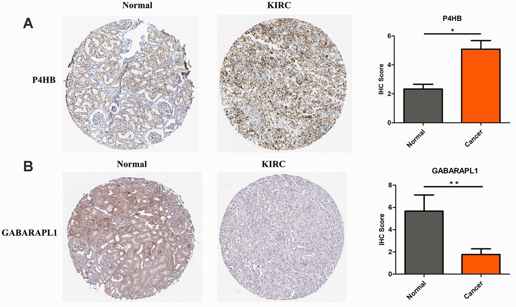 P4HB protein expression was significantly higher in KIRC tissues in comparison with normal tissues, while GABRAPL1 protein expression was significantly lower. Representive IHC images of P4HB (A) and GABRAPL1 (B) in normal (left) and KIRC (middle) tissues. Images were downloaded from HPA Database. Statistical analyses of the protein expression levels of P4HB and GABRAPL1 according to the information of normal and KIRC tissues (right). * pp
