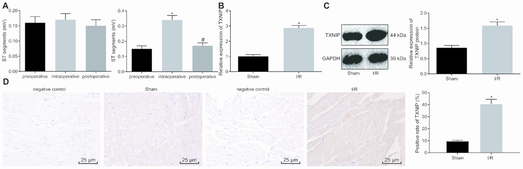 TXNIP is highly expressed in the rat model of I/R. (A) The preoperative, intraoperative and postoperative ST segments (mV) in sham-operated rats (n = 12) (left) and in rats with I/R (n = 72) (right); * p vs. the preoperative ST segment; # p vs. the intraoperative ST segment. (B) TXNIP expression in myocardium determined by RT-qPCR; * p vs. the sham group (sham-operated rats). (C) TXNIP protein expression in myocardium normalized to GAPDH determined by Western blot analysis; * p vs. the sham group (sham-operated rats). (D) The positive expression of TXNIP in myocardium identified by immunohistochemistry (400 ×); * p vs. the sham group (sham-operated rats). Measurement data were presented as mean ± standard deviation. Comparison between two groups was analyzed by unpaired t-test. Comparison among multiple groups was analyzed by one-way analysis of variance, followed by Tukey’s post hoc test. n = 12.