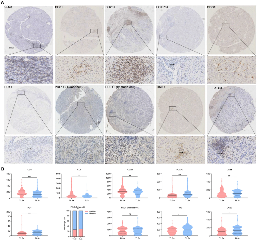 Association between TLS and immune infiltration. (A) Representative images showing immunohistochemical staining of the nine immune markers in immune cells (CD3, CD8, CD20, FOXP3, CD68, PD1, PDL1, TIM3, LAG3) and tumor cells (PDL1); (B) Statistical analyses showing TLS was associated with increased intratumoral CD3+, CD8+, CD20+ and decreased Foxp3+, CD68+ cells infiltration as well as lower density of PD1+, TIM3+ and LAG3+. TLS, tertiary lymphoid structures; *: P