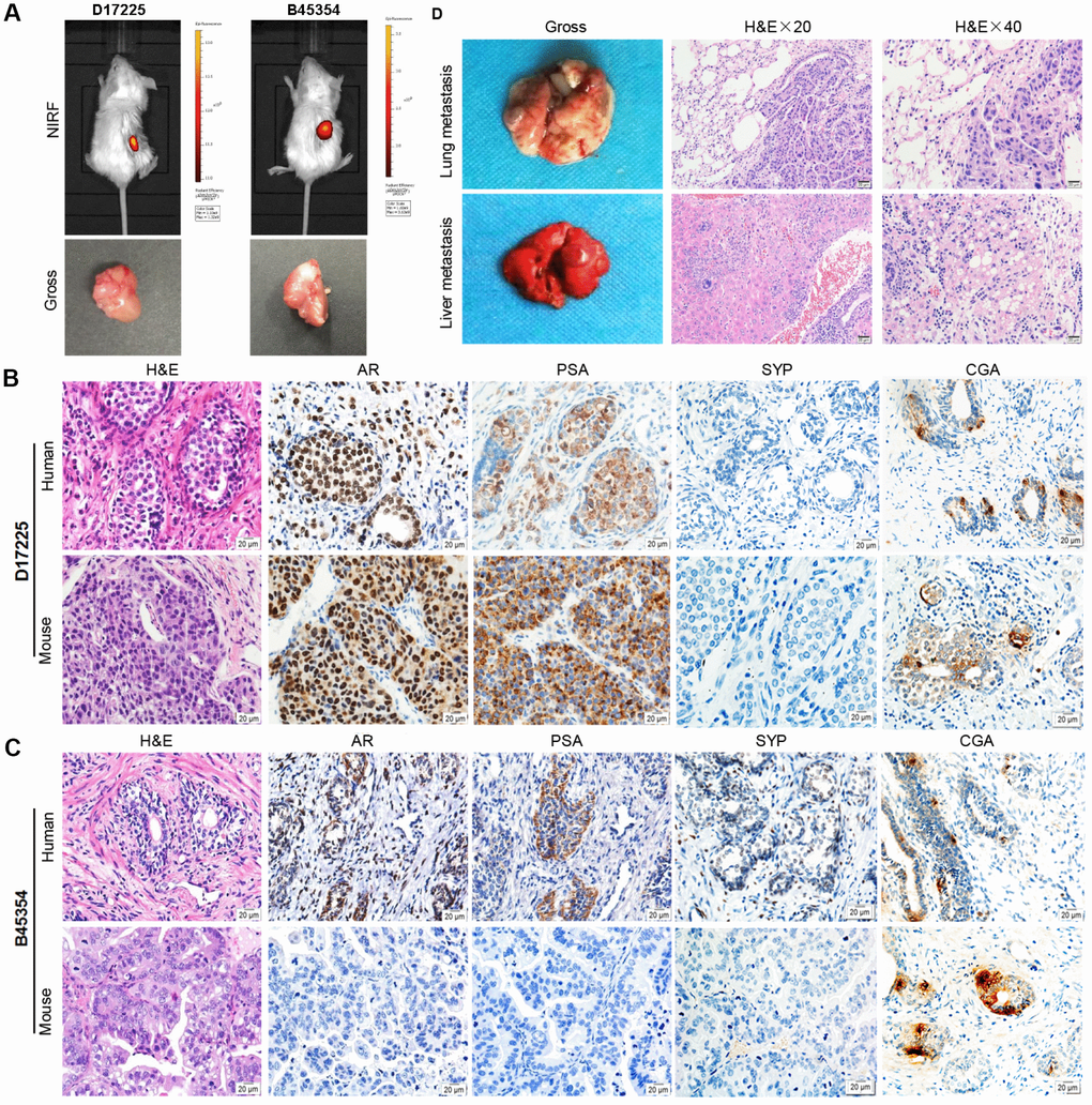Establishment of molecular heterogeneous PDX models with maintained pathological features of patient tumors. (A) NIRF optical imaging of NPG mice with PC xenograft tumors using MHI-148 dye (Top). The PDX models of PC were established by implantation of clinical tumor specimens D17225 and B45353 into the renal capsule of NPG mice. Gross morphology of PC tissue-implanted mouse kidney (bottom). (B, C) H&E and IHC analyses of tumor tissues derived from both PDX models and patient samples (D17225 and B45353). (D) Multiple organ metastasis PDX models from B45354 (CRPC patient). H&E staining of metastatic tumors (including the lung and liver). Original magnification, 400×; scale bars represent 20 μm.