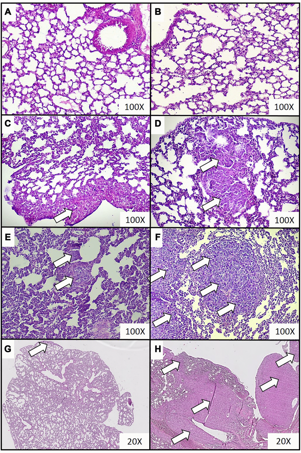 Representative histopathological images of breast cancer metastases in lungs of mice injected with 4T1 cancer cells. Breast cancer metastasis was investigated by histological examination of the lungs isolated from mice during necropsy carried out in animals injected with saline (control) (A) or after 0 (B), 2 (C), 3 (D), 4 (E) and 5 (F) weeks from the injection of 4T1 cancer cells. Hematoxylin and eosin staining, magnification of 100X. Additional images under lower optical magnification (20x) present breast cancer metastasis in samples of lungs resected from mice at the second (G) and fifth (H) week of breast cancer development. Cancer metastases are marked with white arrows. More experimental details are given in the Materials and methods section.