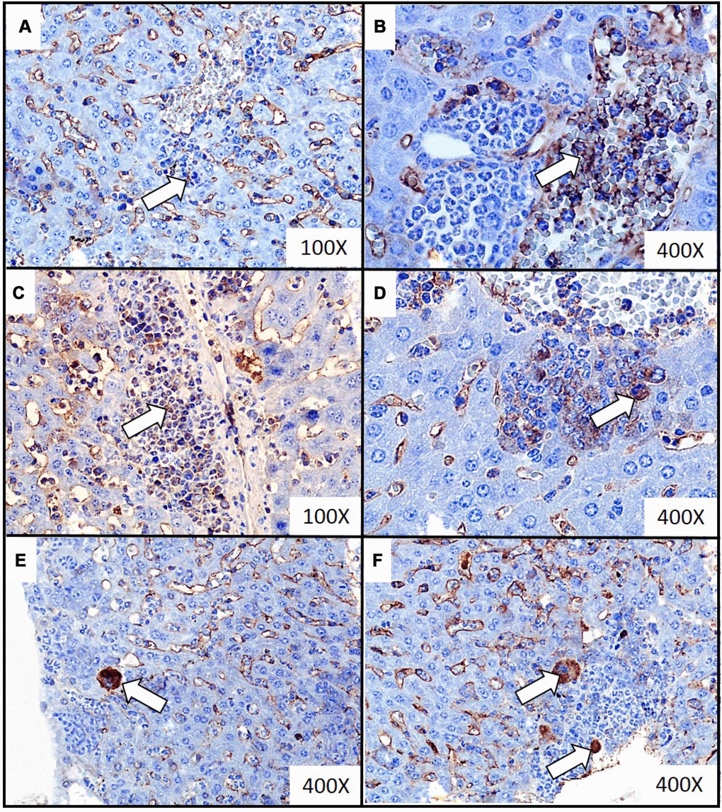 Representative images of immunochemistry detection of the extramedullary hematopoiesis foci in liver of mice injected with 4T1 cancer cells. Extramedullary hematopoiesis was diagnosed by immunohistochemistry staining at time interval t5 in slides from liver isolated during necropsy in mice injected with 4T1-cancer cells. The expressions of hematopoietic markers: CD117 (erythroid marker) (A, B), MPO (granulopoietic marker) (C, D) and FVIII (hematopoietic markers for megakaryocyte) (E, F) were detected. Additional hematoxylin staining was applied. Magnification of 100X (A, C) and 400X (B, D, E, F). Extramedullary hematopoiesis foci are marked with white arrows. More experimental details are given in the Materials and methods section.