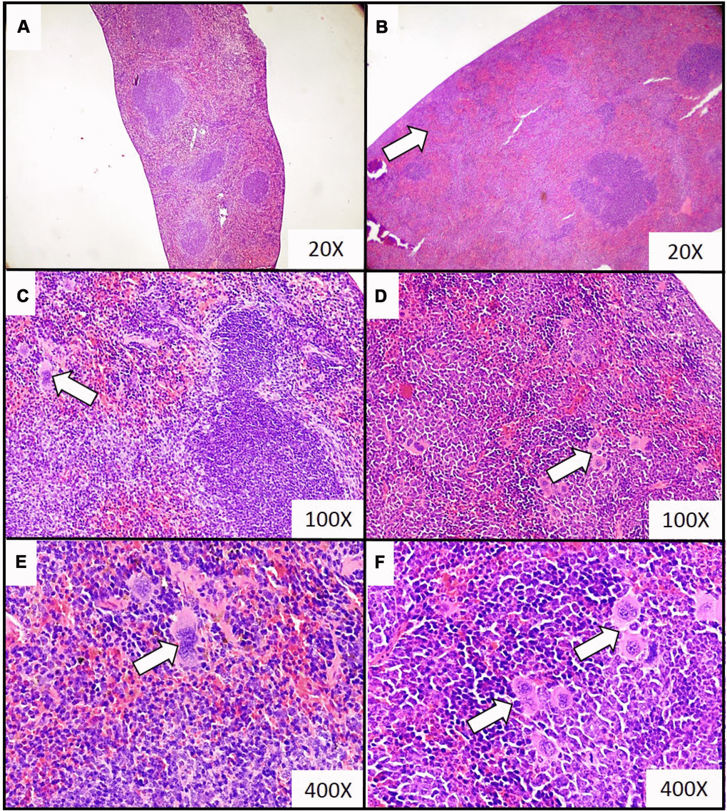 Representative histopathological images of the extramedullary hematopoiesis foci in spleen of mice injected with 4T1 cancer cells. Extramedullary hematopoiesis was diagnosed histologically at time interval t5 in slides from spleens isolated during necropsy in mice injected with saline (control) (A, C, E) or 4T1 cancer cells (B, D, F). Hematoxylin and eosin staining, magnification of 20X (A, B), 100X (C, D) and 600X (E, F). Extramedullary hematopoiesis foci are marked with white arrows. More experimental details are given in the Materials and methods section.