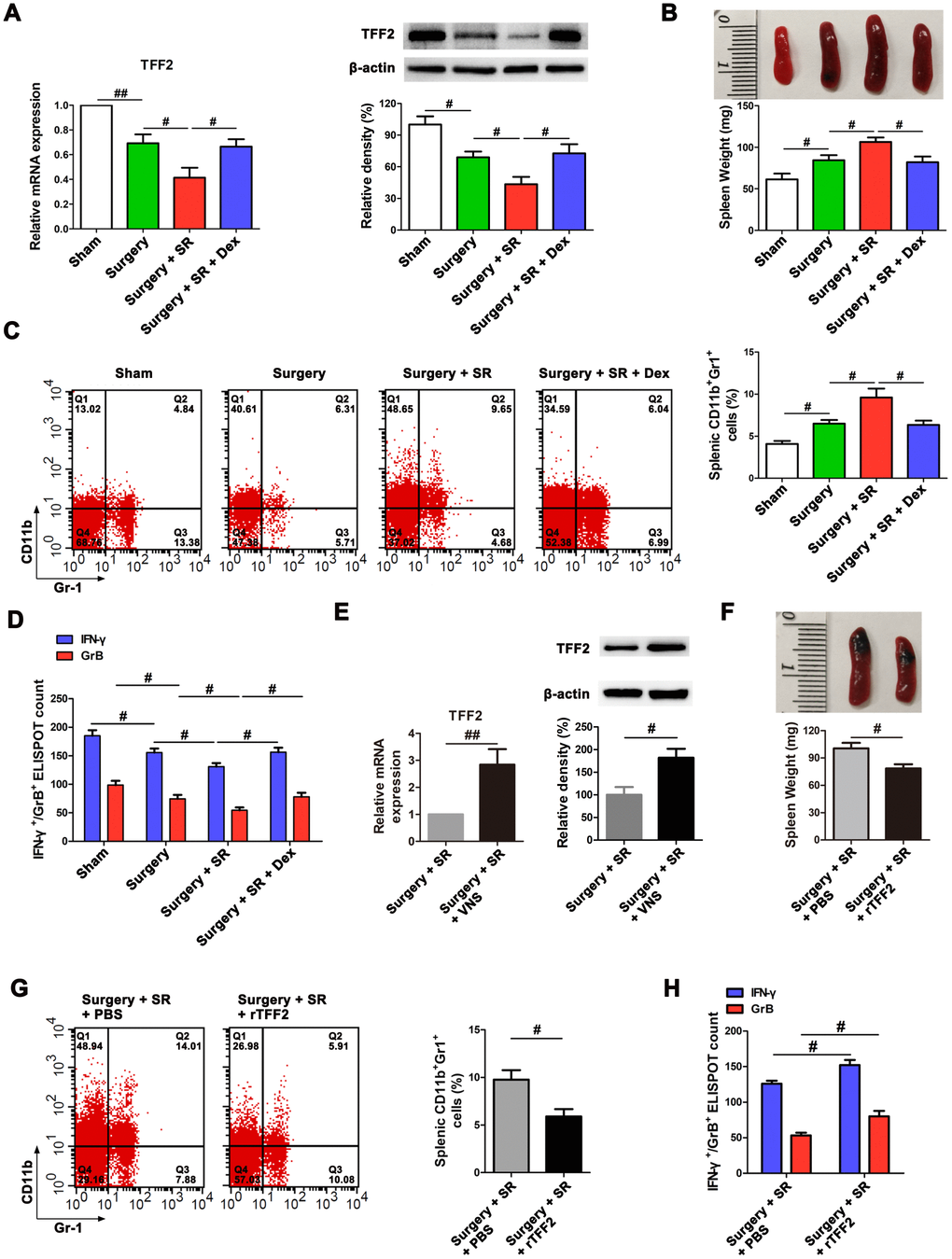 Postoperative sleep-restriction (SR) increased myeloid-derived suppressor cells (MDSCs) expansion and decreased splenic CD8+ cells activity via inhibiting splenic trefoil factor 2 (TFF2). (A) The expression of TFF2 in the spleen of SR mice with or without dexmedetomidine (Dex) treatment was analysed by real-time PCR (RT-PCR and western blotting. (B) Spleen weight in each group after 7 days of SR. (C) Flow cytometry analysis of spleen for CD11b+ Gr-1+ MDSCs in SR mice with or without Dex treatment. (D) The enzyme-linked immunospot (ELISPOT) assay of the levels of interferon-γ (IFN-γ) and Granzyme B (GrB) in splenic CD8+ T cells from SR mice with or without Dex treatment. (E) The mRNA and protein expression of TFF2 in the spleen were analysed by RT-PCR and western blotting in SR mice with or without vagus nerve stimulation (VNS). (F) Spleen weight in SR mice with the treatment of recombinant human TFF2 protein (rTFF2) or PBS. (G) Flow cytometry analysis of spleen for CD11b+ Gr-1+ MDSCs in SR mice with the treatment of rTFF2 or PBS. (H) ELISPOT assay of the levels of IFN-γ and GrB in splenic CD8+ T cells from SR mice with the treatment of rTFF2 or PBS. All data represent mean ± SEM, n = 5; #P ##P 
