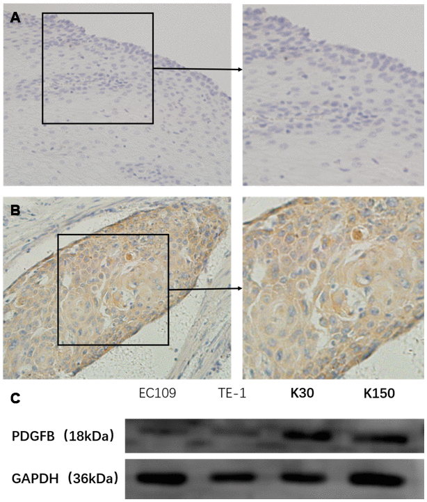 PDGF-BB expression in esophageal squamous cell carcinoma tissues and cell-lines was studied in a total of 41 cancer tissues (62.1%) of all 66 cases, and these cases had high expression (score: A) while the expression was low in all 4 normal adjacent operative tissues (B) by immunohistochemistry. In addition, Western blotting showed that the levels of PDGFB were positively expressed in the 4 esophageal squamous cell carcinoma cell-lines (C).
