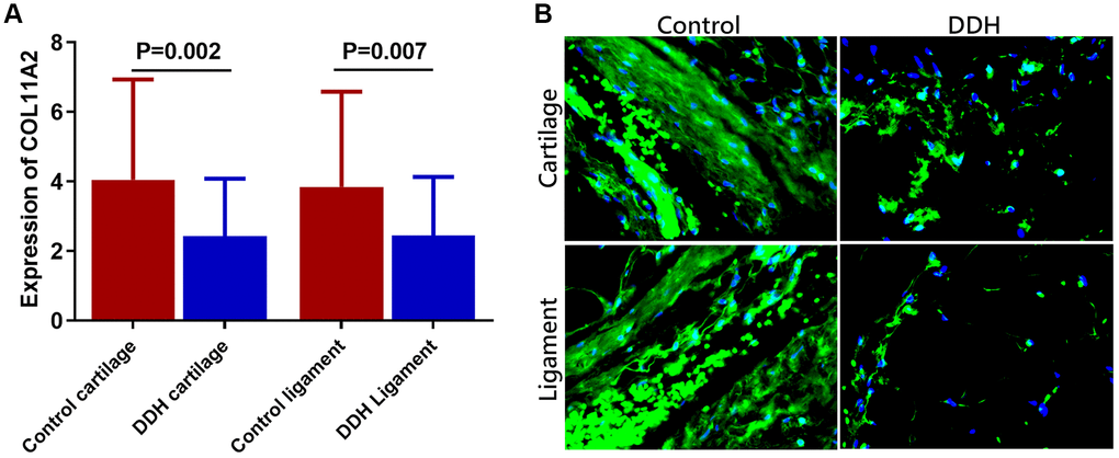 Tissue expression of COL11A2 in patients and controls. (A) DDH patients were found to have significantly lower expression of the COL11A2 in the articular cartilage and ligament as compared with the controls (2.43 ± 1.65 vs 4.05 ± 1.89, p = 0.002 for articular cartilage; 2.46 ±1.68 vs. 3.85 ± 2.73, p = 0.007 for joint ligament). (B) Immunofluorescent assay of COL11A2 (green) expression and nucleus (blue) in the cartilage and ligament tissues in different groups of patients observed under confocal microscopy.