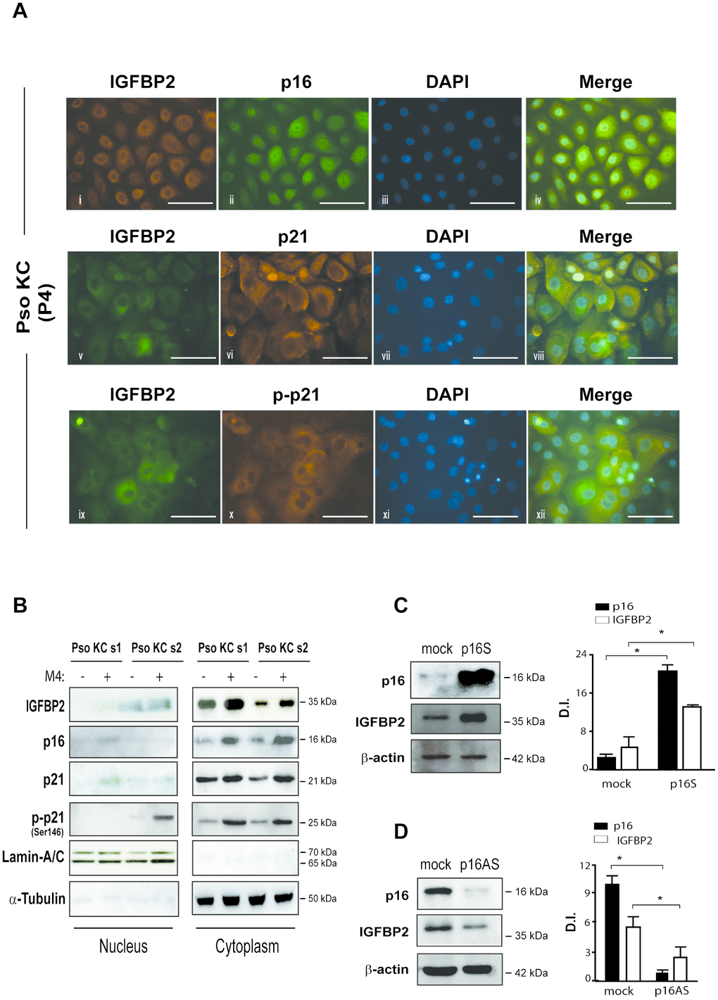 IGFBP2 co-localizes with p21 in the cytoplasm of senescent psoriatic keratinocytes and its expression is positively regulated by p16. (A) Immunofluorescence analysis was conducted on pso KC cultures (n = 3) at passage 4 (P4) to evaluate IGFBP2, p16, p21 and p-p21 subcellular localization. Cells were immunostained with anti-IGFBP2 Ab, followed by Cy3-conjugated secondary Ab (orange, panel i) or by Alexa Fluor 488-conjugated secondary Ab (green, panel v, ix), or, alternatively with p16 followed by Alexa Fluor 488 secondary Ab (green, panel ii), and p21 or p-p21 primary antibodies followed by Alexa Fluor 555 secondary Ab (orange, panels vi, x). Nuclei were counterstained with DAPI (blue) and the merging of three patterns was shown within the same field (merge, panels iv, viii, xii). Bars, 100 μM (B) IGFBP2, p16, p21 and p-p21 expression was analysed by WB on nuclear and cytosolic protein fractions obtained from two different pso KC strains (pso KC s1; pso KC s2), left untreated or treated with M4 for 18 hours. The quality of nuclear and cytosolic fractions was assessed by detection of lamin A/C and α-tubulin, respectively. (C) WB analysis was performed on lysates from primary human KC transduced with empty vector (mock) or p16 sense (p16S) vector and analysed for p16 and IGFBP2 expression. (D) Similarly, p16 and IGFBP2 expression was evaluated by WB on protein lysates obtained from primary KC cultures transduced with empty (mock) or antisense (p16AS). In (C, D), graphs show the means of the densitometric intensity (D.I.) of the bands ± SD, obtained from three independent experiments. *p ≤ 0.05, as calculated by Mann–Whitney U test.