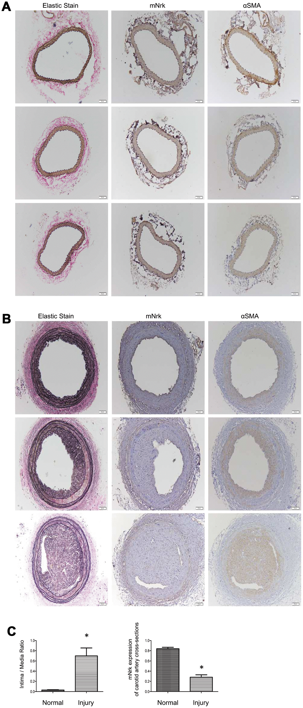 Expression of mNrk, αSMA, and elastic staining in carotid artery of wild-type C57BL/6 mice subjected to guide wire injury for 4 weeks. The expression of mNrk, αSMA, and elastic staining in three set of sections of (A) non-injured and (B) injured carotid arteries at 150-μm intervals was examined by immunohistochemical staining. Bar = 50 μM. (C) Left panel: Quantitation of intima/media (I/M) ratio (left panel, p = 0.00056) and Nrk expression (right panel, p = 1.184 × 10-5) in normal and injured carotid arteries. n = 9 for each group.