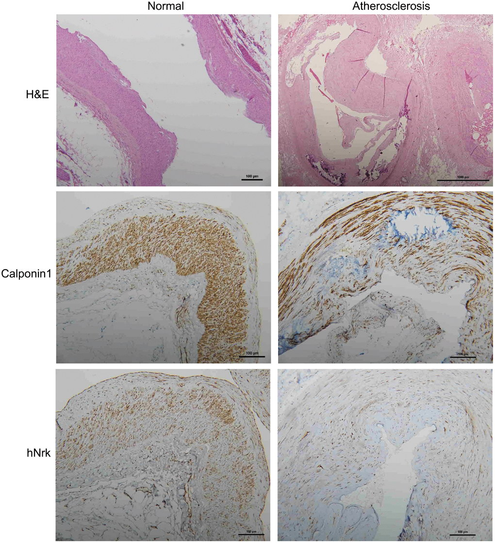 Representative immunohistochemical staining of hNrk and calponin 1 in human normal (left panels) and atherosclerotic (right panels) vessels. Bar = 100 μm.