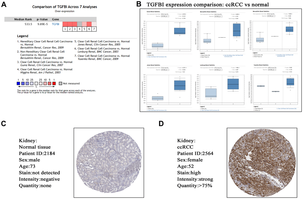 Validation of hub gene (TGFBI) in mRNA level (A, B) by Oncomine database and translational level (C, D) by The Human Protein Atlas database (IHC).
