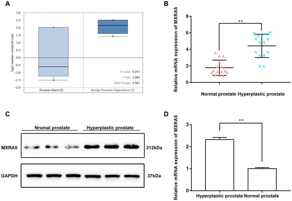 MXRA5 is strongly upregulated in BPH tissues compared with the normal ones. (A) Upregulation of MXRA5 mRNA expression in BPH analyzed by Oncomine database. Analysis using the Oncomine database revealed increased MXRA5 at transcriptional level in BPH stromal tissues versus normal prostate stroma. (B) qRT-PCR analysis showed that the gene expression of MXRA5 in BPH tissues (n = 15) was significantly higher than the normal prostate tissues (n = 15). The GAPDH mRNA was used as an internal control, ** means PC) Western blot analysis revealed a strongly increasing protein abundance of MXRA5 in BPH tissues versus normal ones. (D) Relative densitometric quantification of MXRA5 protein in BPH tissues versus normal ones. GAPDH expression was analyzed as a loading control, results are expressed as ratio of the proteins in respect to GAPDH. ** means P 