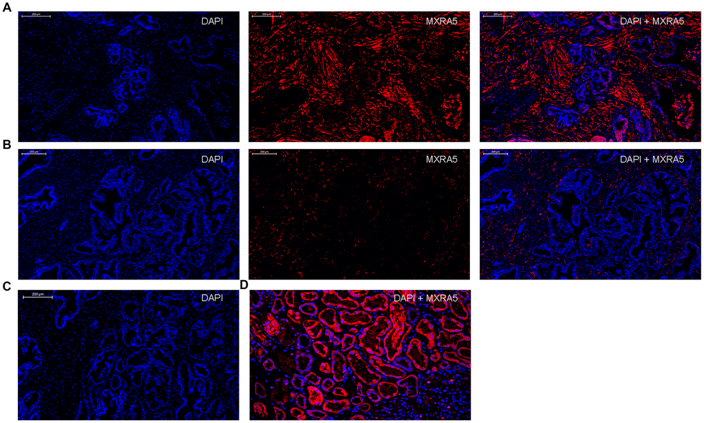 Immunofluorescence localization of MXRA5 in human prostate tissues. (A) Human BPH tissues. Left: DAPI (blue) indicates nuclear staining. Middle: Cy3-immunofluorescence (red) indicates the MXRA5 protein which was observed mainly in the fibromuscular stroma. Right: Merged image. (magnification ×200). (B) Human normal prostate. Left: DAPI (blue) indicates nuclear staining. Middle: Cy3-immunofluorescence (red) indicates MXRA5 protein. Right: Merged image (magnification ×200). (C) Negative controls omitting the primary antibody failed to stain. (D) Positive control using human renal cortex tissue showed a strong immune positivity for MXRA5 protein. DAPI (blue) indicates nuclear staining and Cy3-immunofluorescence (red) indicates MXRA5 protein staining (magnification ×200). Sections of all sample were used for immunofluorescence experiments and representative graphs were selected into figure.