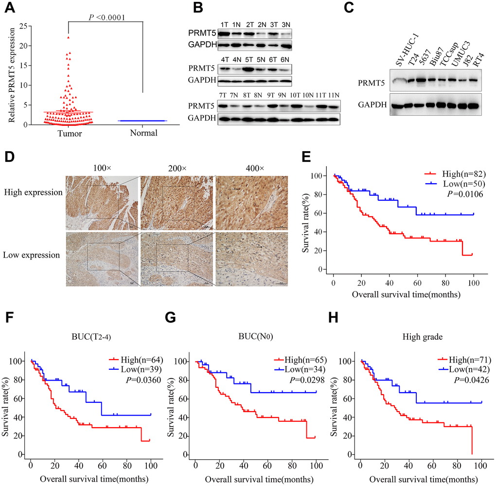 PRMT5 was upregulated and demonstrated prognostic significance in bladder cancer. (A) PRMT5 mRNA expression was significantly upregulated in bladder cancer tissue compared with that in adjacent normal tissues via qRT-PCR. (B) The PRMT5 protein level was upregulated in 11 pairs of bladder cancer tissues. (C) PRMT5 expression was upregulated in bladder cancer cell lines compared with immortalized human bladder epithelial SV-HUC-1 cells. (D) Representative images of immunohistochemistry of PRMT5 in bladder cancer tissues. (E) The Kaplan-Meier curve was applied to the survival analysis of bladder cancer patients with different PRMT5 expression levels from SYSUCC cohorts. (F–H) Positive correlation between overall survival and different PRMT5 expression levels from SYSUCC bladder cancer patients with muscle-invasive bladder cancer (F), absence of lymph node metastasis (G), and high-grade tumors (H). SYSUCC: Sun Yat-Sen University Cancer Center.
