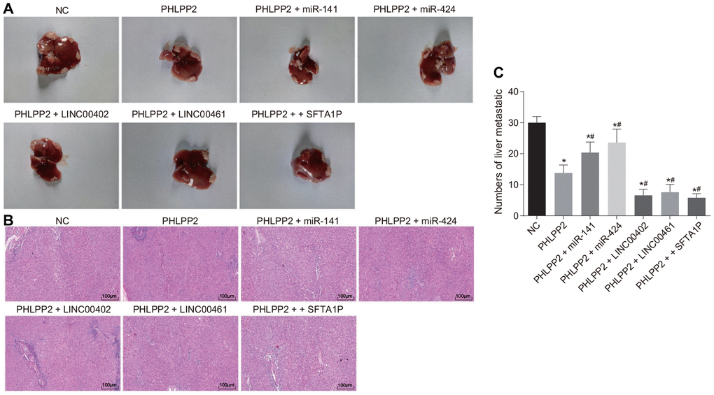 The attenuation of PHLPP2 on tumor metastasis and formation is enhanced by the overexpression of LINC00402, LINC00461 and SFTA1P or reduced by miR-141 and miR-424. Nude mice were injected with cell suspension carrying HT-29 cells transfected with NC, PHLPP2, PHLPP2 + miR-141, PHLPP2 + miR-424, PHLPP2 + LINC00402, PHLPP2 + LINC00461 or PHLPP2 + SFTA1P. (A) Representative images of the liver lesion in the liver tissues of nude mice. (B) HE staining of liver tissues (100 ×) in nude mice revealed the number of liver metastatic nodules. (C) The numbers of liver metastatic nodules in nude mice 8 weeks counted by HE staining. * p vs. the NC group; # p vs. the PHLPP2 group. Measurement data in this Figure were expressed as the mean ± standard deviation, and comparisons among multiple groups were conducted by One-Way ANOVA (n = 5); the experiment was repeated three times independently.