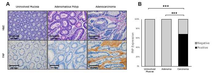 Immunohistochemical FAP staining along the adenomatous polyp-cancer sequence of CRC. (A) 68,3% of adenocarcinomas were positively stained. Uninvolved colorectal mucosa and adenomas were negative (x200). (B) FAP staining was scored as negative or positive. The scores were quantified in each tissue type and statistical significance of the FAP expression pattern among the different tissues was determined by Chi-Square test (*** p