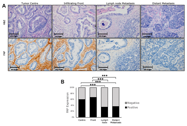 Immunohistochemical FAP expression in primary (centre and border) and corresponding metastatic (lymph node and liver) tissues of conventional adenocarcinomas (AdCs). (A) Higher percentage of positive staining was observed in primary tumours than in metastases (x200). (B) FAP staining intensity was scored as negative or positive. The scores were quantified in each tissue type and statistical significance of FAP expression pattern among the different tissues was determined by Chi-Square test (***p