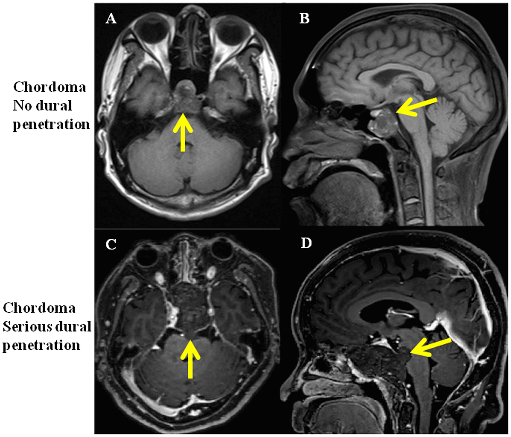 MRI of clival chordoma patients with no dural penetration and with serious dural penetration. (A, B) Same chordoma patient with no dural penetration, yellow arrows show the integrity of dura mater; (C, D) Same chordoma patient with serious dural penetration, yellow arrows show tumor penetrate the dura mater and invade into intracranial space.
