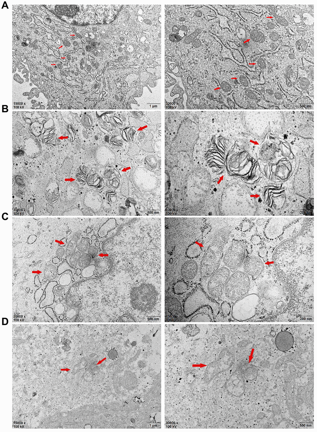 After 72 hours of PDLSCs culture in four different media, the microstructure changes of each group were observed by transmission electron microscopy: (A) Control Group; (B) Cells were treated with 10ng/mL TNF-α; (C) Cells were treated with 100μg/mL AGEs-BSA; (D) Cells were treated with 100μg/mL AGEs-BSA and 10ng/mL TNF-α.
