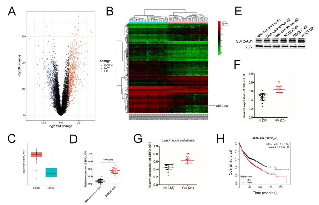 Overexpression of SBF2-AS1 correlates with clinicopathological features and poor prognosis in patients with NSCLC. (A) Volcano plot showing the upregulated and downregulated lncRNAs in the expression microarray (GSE19804 dataset). (B) Heatmap visualization of differentially expressed lncRNAs in normal vs lung cancer tissues (GSE19804 dataset). (C) Expression of SBF2-AS1 in normal and lung cancer tissues. Data represent log2 expression values. (D) Quantitative qRT-PCR analysis of SBF2-AS1 expression in 56 human NSCLC tissues and the paired non-cancerous tissues. **PE) The expressions of SBF2-AS1 in NSCLC tissues and non-cancerous tissues were detected using northern blotting assay. (F) The expression levels of SBF2-AS1 in patients with different stage. **PG) The expression levels of SBF2-AS1 in patients with or without metastasis. **PH) Kaplan-Meier survival analysis of overall survival rate between NSCLC patients with low or high SBF2-AS1 expression. High SBF2-AS1 was a predictor for poor overall survival of NSCLC patients as analyzed at Kaplan-Meier plotter website.