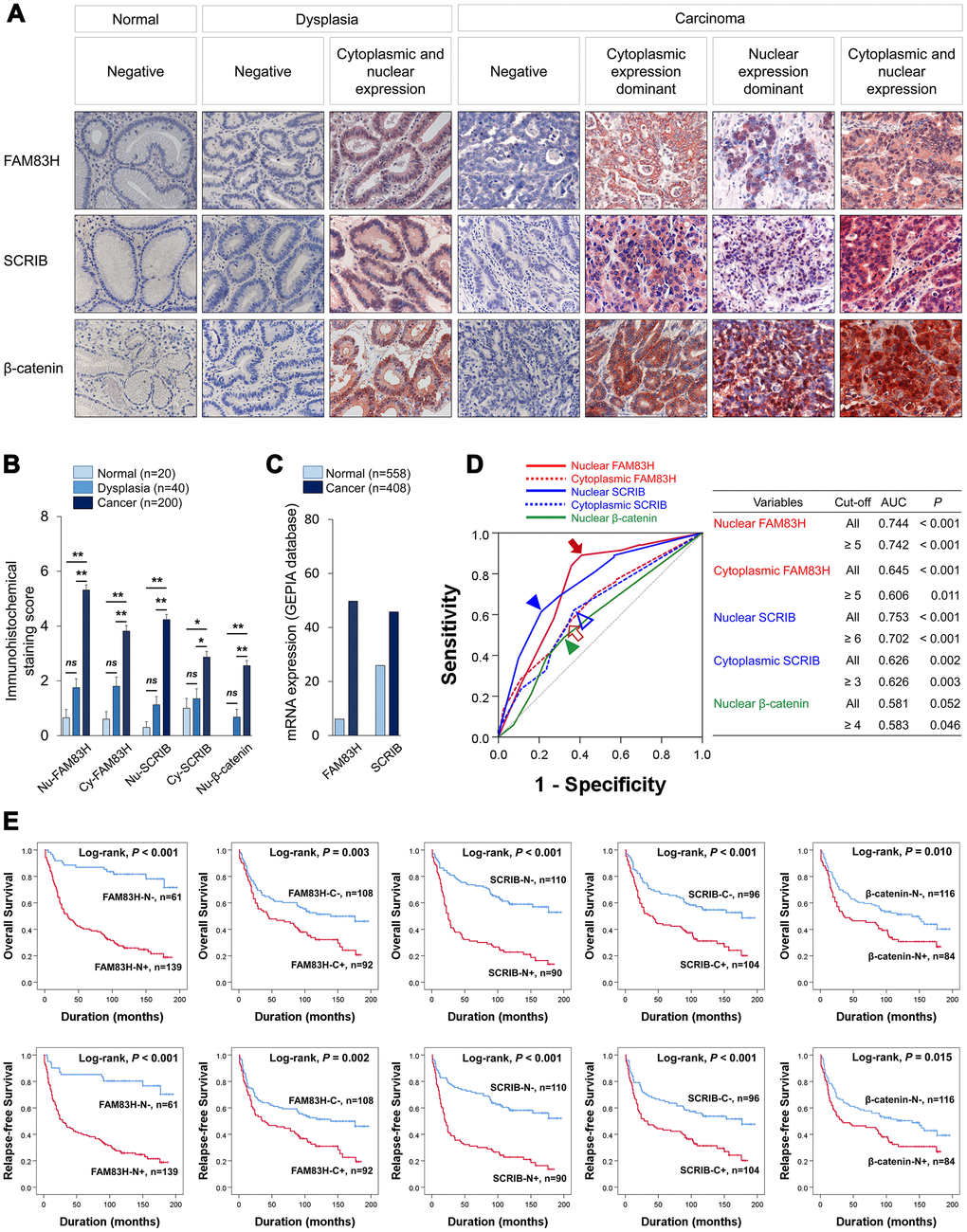 Expression and prognostic significance of the expression of FAM83H, SCRIB, and β-catenin in 200 human gastric carcinomas. (A) Immunohistochemical expression of FAM83H, SCRIB, and β-catenin in normal gastric mucosa, gastric dysplasia, and gastric carcinoma tissue. FAM83H and SCRIB are expressed in both the cytoplasm and nuclei of tumor cells. Original magnification: x400. (B) Immunohistochemical staining scores for nuclear FAM83H (FAM83H-N), cytoplasmic FAM83H (FAM83H-C), nuclear SCRIB (SCRIB-N), cytoplasmic SCRIB (SCRIB-C), and nuclear β-catenin (β-catenin-N) in 20 normal gastric mucosa, 40 gastric dysplasia, and 200 gastric carcinomas. (C) The expression of mRNA of FAM83H and SCRIB in normal gastric tissue and gastric cancers from the GEPIA database (http://gepia.cancer-pku.cn. Accessed 10 January 2020). (D) ROC curve analysis to determine cut-off points for the expression of FAM83H-N (red arrow), FAM83H-C (red empty arrow), SCRIB-N (blue arrowhead), SCRIB-C (blue empty arrowhead), and β-catenin-N (green arrowhead). The cut-off points are determined at the point of the highest area under the curve (AUC) to predict the death of gastric carcinoma patients. (E) Kaplan-Meier survival analysis of overall survival and relapse-free survival according to the FAM83H-N, FAM83H-C, SCRIB-N, SCRIB-C, and β-catenin-N expression.