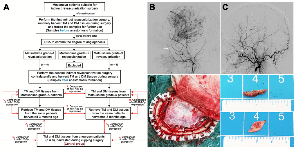 Harvesting of clinical samples. (A) Schedule of TM and DM sample harvesting. DSA films showing Matsushima grade-A revascularization (B) and Matsushima grade-C revascularization (C). The white arrows indicate the deep temporal artery, and the black arrows indicate the middle meningeal artery. (D) Intraoperative image showing the sources of the TM and DM samples. TM: temporal muscle; DM: dura mater.