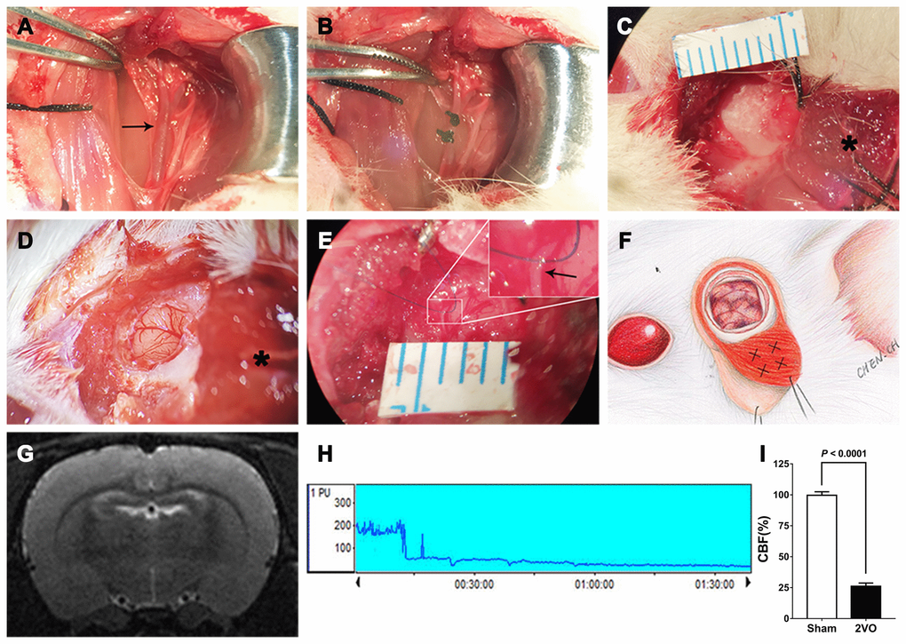 Procedures used for establishment of the 2VO+EMS rat model. (A, B) Procedures used for CCA ligation (the black arrow indicates the left CCA). Representative images showing the EMS procedures, including (C) reflection of the skin and TM from the skull, (D) opening of the dura (the black asterisk indicates the TM tissue) and (E) stitching of the TM and DM with 10-0 Prolene (the black arrow indicates the DM). (F) Schematic drawing showing the EMS procedure and the four injection sites for the miR-126-5p agomir in the TM. (G) MRI-T2 film showing a lack of infarction after the 2VO procedures. (H) Representative graph of CBF changes before and after 2VO. (I) Doppler flowmetry results showing that the CBF values in 2VO rats (n = 8) decreased to 25.8 ± 2.6% of the baseline levels obtained for the 2VO sham group (n = 8). The error bars represent the ±SDs. EMS: encephalo-myo-synangiosis; TM: temporal muscle; DM: dura mater; CBF: cerebral blood flow; CCA: common carotid artery.