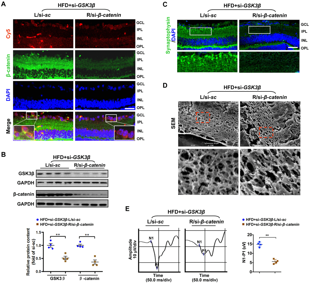 Knock-down of β-catenin abrogated the protective effect of GSK3β depletion on HFD-induced diabetic retinal neurodegeneration. A Cy5-labeled si-β-catenin was intravitreally co-injected with si-GSK3β into the right eye of HFD-induced diabetic mice (HFD+si- GSK3β/R-si-β-catenin), while scramble si-sc was co-administrated with si-GSK3β in the contralateral left eye as a control (HFD+si-GSK3β/L-si-sc). (A) Representative immunofluorescence for active β-catenin (green, active β-catenin; red, Cy5; blue, DAPI; scale bar, 100 μm). Areas boxed in are shown at higher magnification. (B) Western blotting for GSK3β and active β-catenin. Relative intensities were quantified. (C) Representative retinal immunofluorescence staining for synaptophysin (green; scale bar, 100 μm). Areas boxed in are shown at higher magnification. (D) Representative SEM of retinal sections. Areas boxed are shown at higher magnification. Scale bar, 10 μm. (E) Representative waveforms of VEP and quantification of differences in peak amplitude (N1-P1). Data are means ± SEM. n = 4 eyes per group. **P sc. See also Supplementary Figures 2E, 3E and 4C.