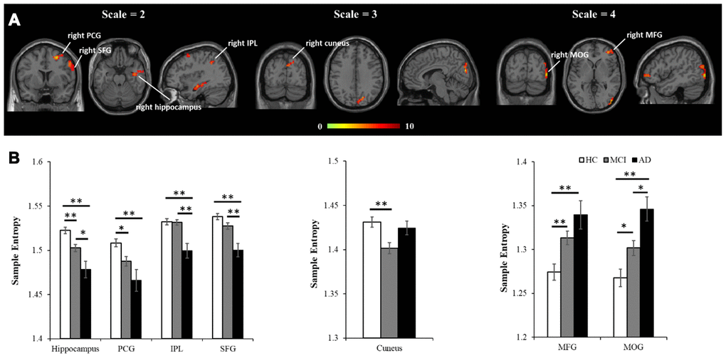 MSE differences across the three groups using voxel-wise ANCOVA, controlled for age, education, head motion, and GM. (A) Significant differences of MSE were observed in multiple brain regions, including four regions in scale = 2 (the right hippocampus, right PCG, right IPL and right SFG), one region in scale = 3 (the right cuneus), and two regions in scale = 4 (the MFG and MOG). All the statistical results were corrected for multiple comparisons (p B) The peak entropy value within each region was extracted and used to examine the differences between each pair of groups (p