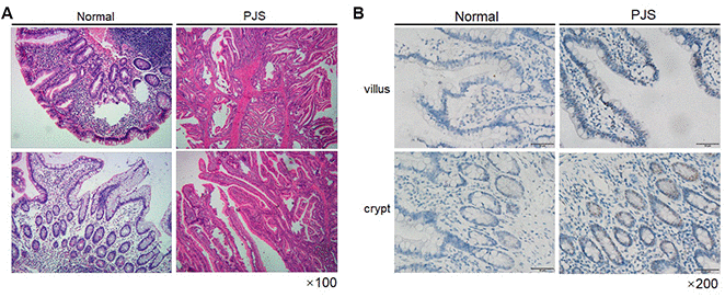 Survivin expression is increased in intestinal PJS polyps. (A) HE staining of an intestinal polyp from a PJS patient. (B) IHC detection of survivin expression in intestinal villi and crypts from PJS and control samples.