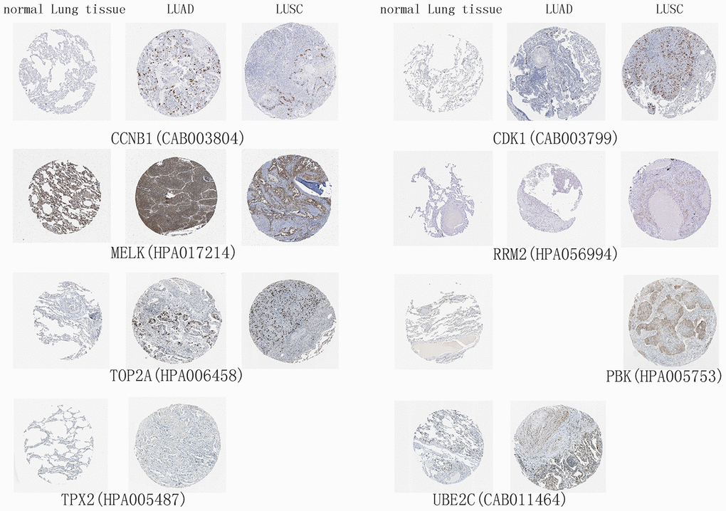 High expression of hub genes in immunohistochemistry. Normal Lung tissue samples are on the left, lung adenocarcinoma (LUAD) samples are in the middle, and lung squamous cell carcinoma (LUSC) samples are on the right.