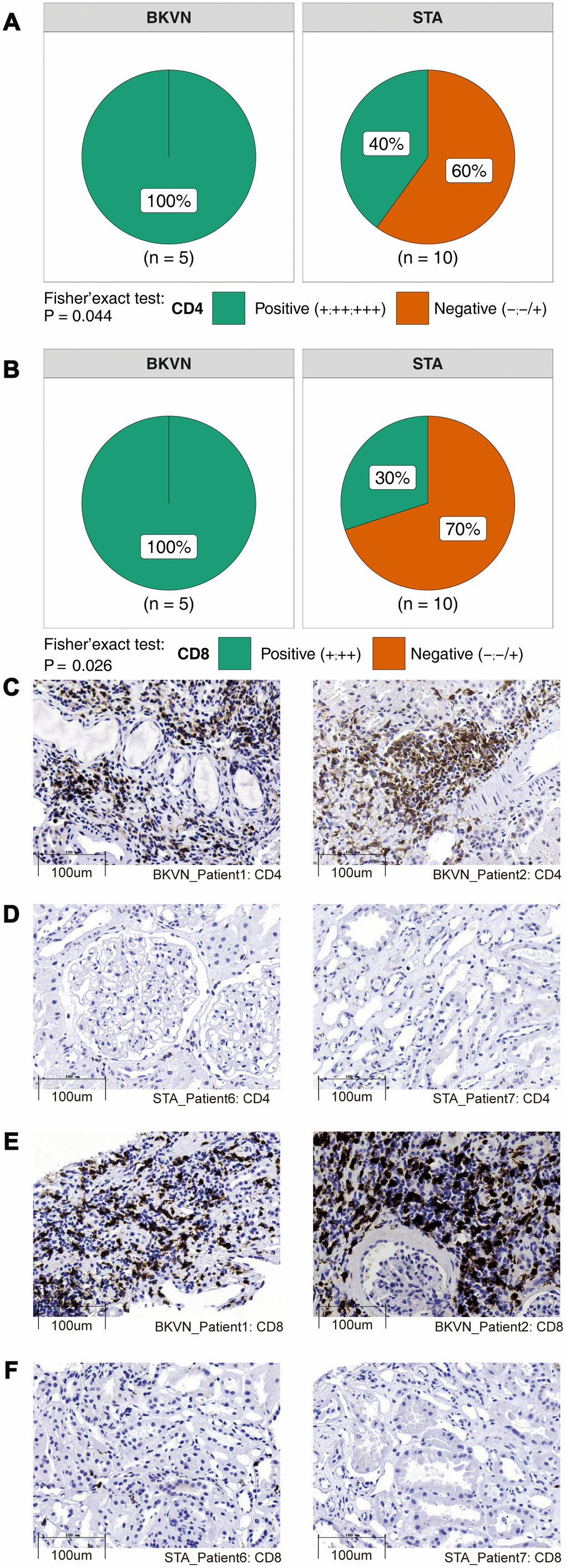 Comparison of immunohistochemical characterization of the CD4+ and CD8+ cells between BKVN and STA. (A, B) BKVN was associated with increased CD4+ (A) and CD8+ cells (B). (Fisher's exact test). (C–F) Immunohistochemical features (CD4 and CD8) of BKVN and STA.