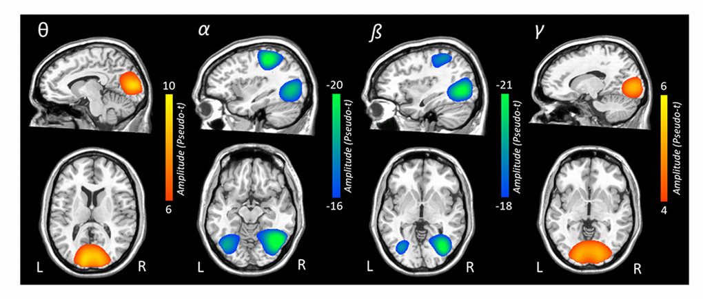Grand-averaged beamformer images (pseudo-t) for each oscillatory response. In each image, data from both conditions and all participants have been grand averaged. Theta responses were strongest in bilateral medial occipital cortices. In contrast, robust decreases in alpha activity were seen in more lateral occipital cortices bilaterally and the left superior parietal lobule. Decreases in beta activity were also observed in bilateral occipital cortices and the left intraparietal sulcus. Gamma-frequency responses were strongest in the medial bilateral visual cortices.