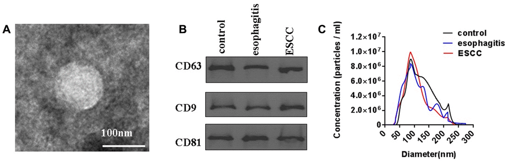 Characterization of plasma exosomes from ESCC patients, esophagitis patients, and healthy controls. (A) Shape and structure of plasma exosomes isolated by ultracentrifugation under TEM. (B) Western blots of exosome membrane markers CD63, CD9, and CD81. (C) Sizes of plasma exosomes from ESCC patients, esophagitis patients, and healthy controls were analyzed by NTA.