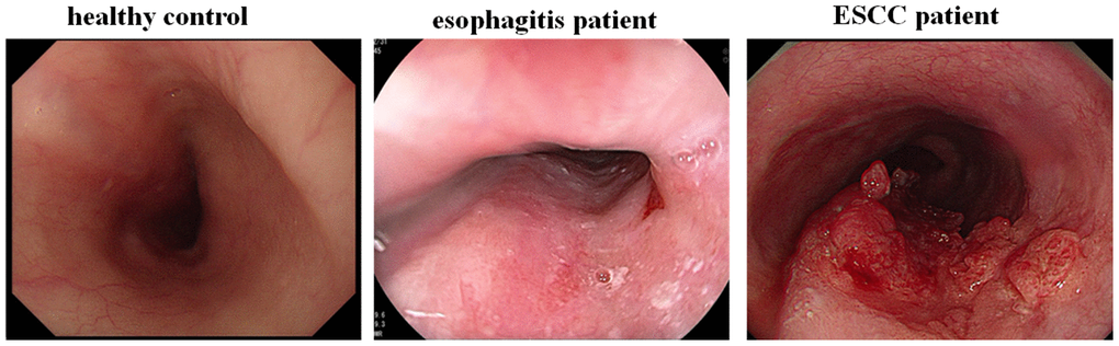 Endoscopic examination of ESCC patients, esophagitis patients and healthy controls.