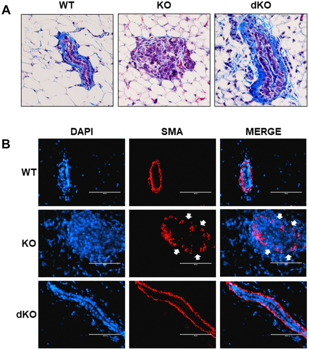 Collagen and smooth muscle actin layer remain uninterrupted in Cav-1/STAT5a dKO mice mammary ducts following estrogen treatment. (A) Mammary glands of estrogen-treated WT, Cav-1 KO, and Cav-1/STAT5a dKO mice were stained with Masson’s trichrome to highlight the collagen (blue staining) lining the outside of the basement membrane of the ducts. Qualitatively, Cav-1 KO mammary glands stimulated with estrogen demonstrated a complete degradation of collagen surrounding the basement membrane, whereas WT ducts showed intact collagen deposition. Deletion of STAT5a from estrogen-treated Cav-1 KO mice restored collagen deposition to WT levels. For each experimental group, trichrome staining was performed in triplicate on mammary glands derived from 3 independent mice. (B) Mammary glands of estrogen-treated WT, Cav-1 KO, and Cav-1/STAT5a dKO mice were immunostained with an antibody recognizing alpha smooth muscle actin (SMA) to highlight the myoepithelial cells lining the inside of the basement membrane of the ducts. DAPI was used as a nuclear counterstain. The EVOS FL microscope was used to capture images at 40x objective with the DAPI and Texas Red light cubes (blue: DAPI immunostaining; red: SMA immunostaining). Qualitatively, the SMA layer surrounding estrogen-treated Cav-1 KO mammary ducts was disrupted (white arrows indicate breaks in the myoepithelial cells), but completely intact around WT ducts. Cav-1 KO mice lacking STAT5a expression maintained an intact SMA layer similar to WT mice. For each experimental group, immunofluorescence was performed in triplicate on mammary glands derived from 3 independent mice.
