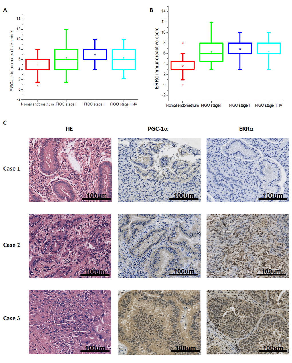 Expression of PGC-1α and ERRα in normal endometrium and endometrial cancer tissue. Expression of PGC-1α (A) and ERRα (B) in normal endometrium and different clinical stage endometrial cancer. (C) HE staining and immunohistochemical staining of PGC-1α, ERRα in normal endometrium (Case 1), superficial myometrial invasion EC (Case 2) and deep myometrial invasion EC (Case 3).